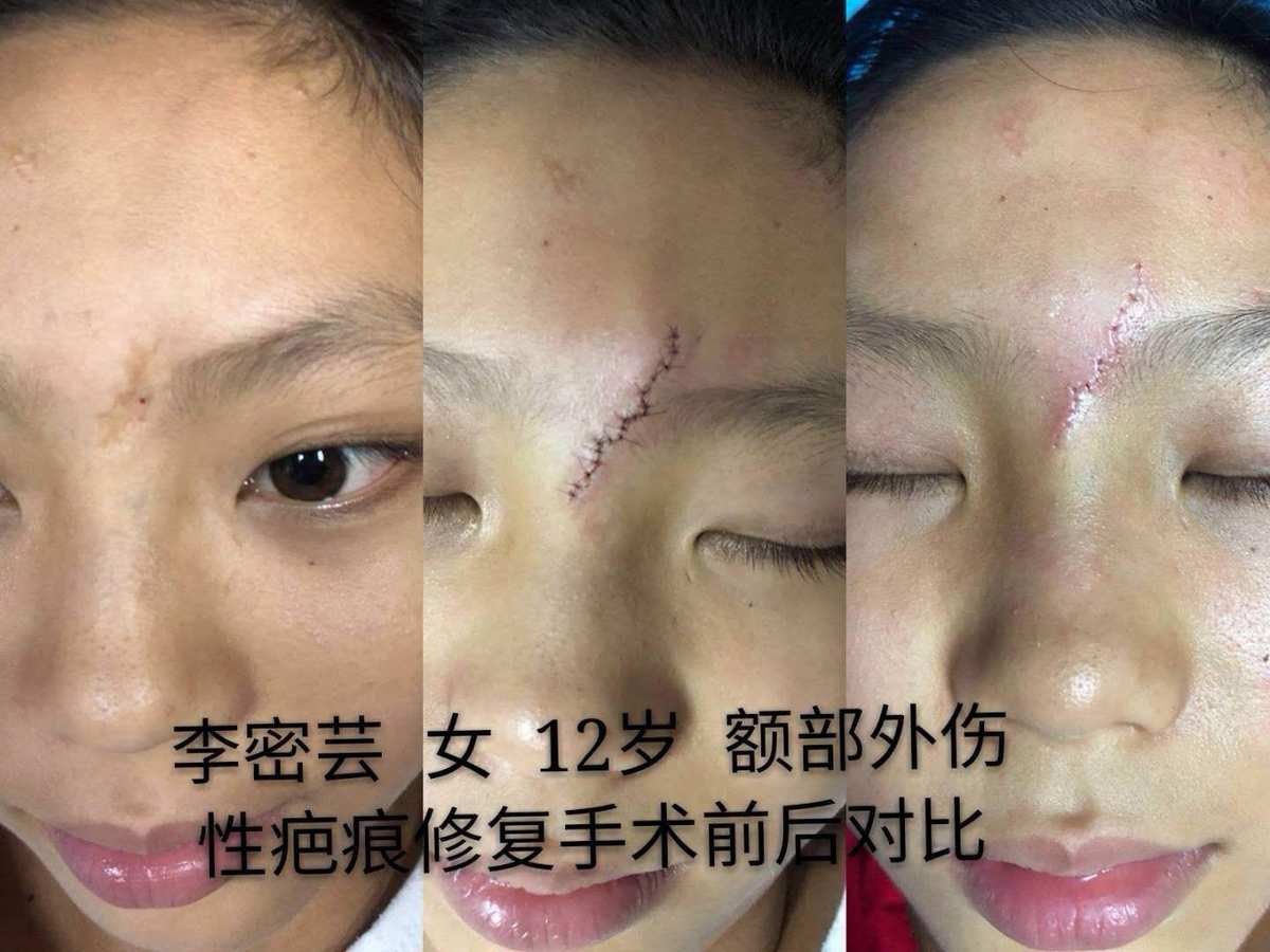 美容院祛疤价格_美容医院除疤大概多少钱_