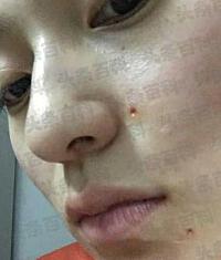 美容院祛疤价格__美容医院除疤大概多少钱
