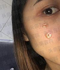 美容医院除疤大概多少钱__美容院祛疤价格